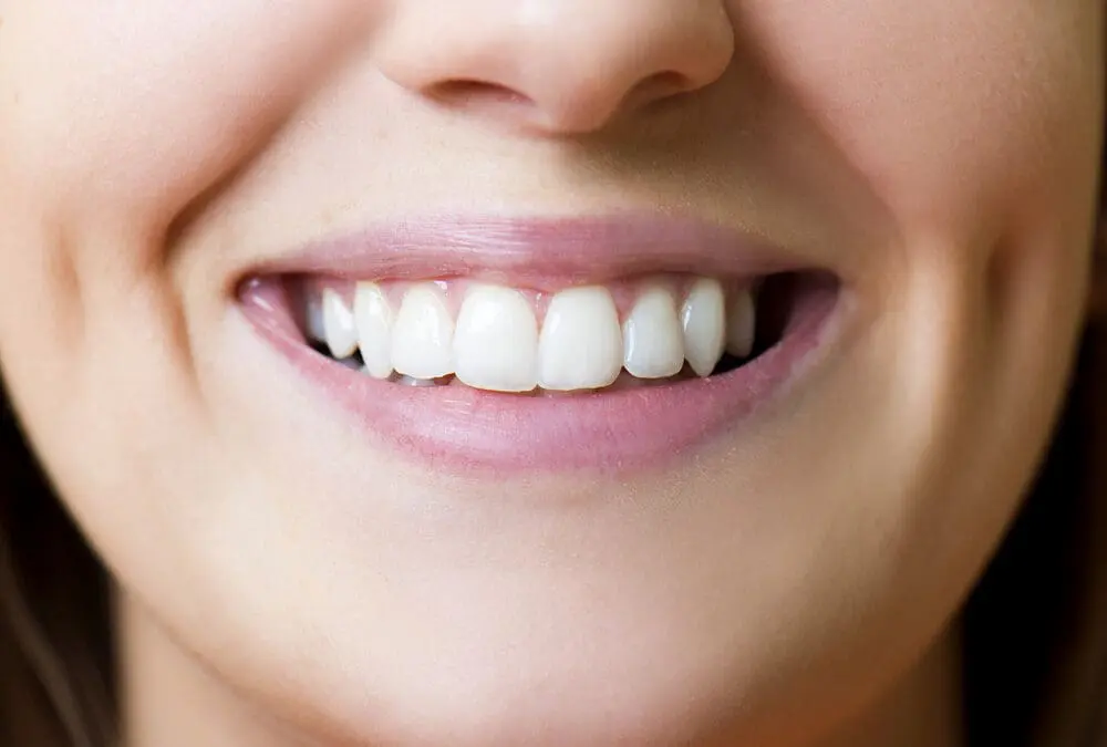 Understanding the Veneer Implant Process With Cosmetic Dentists